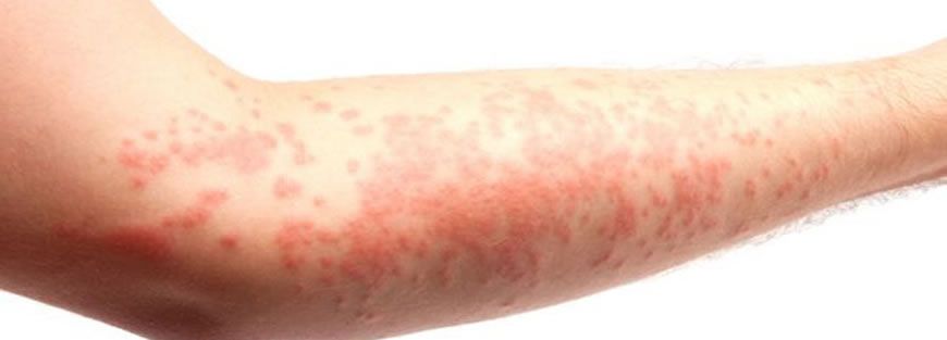Dermatites