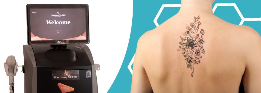 Remoção de Tatuagem