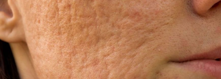Acne e Cicatrizes de Acne