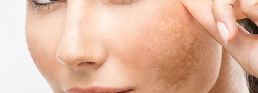 Melasma