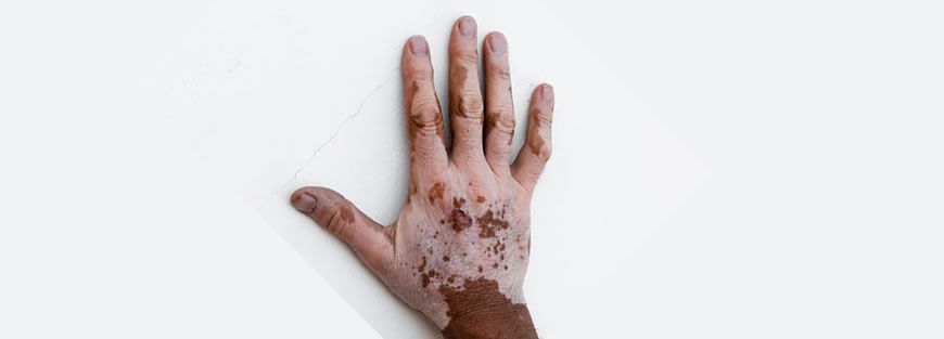 Vitiligo